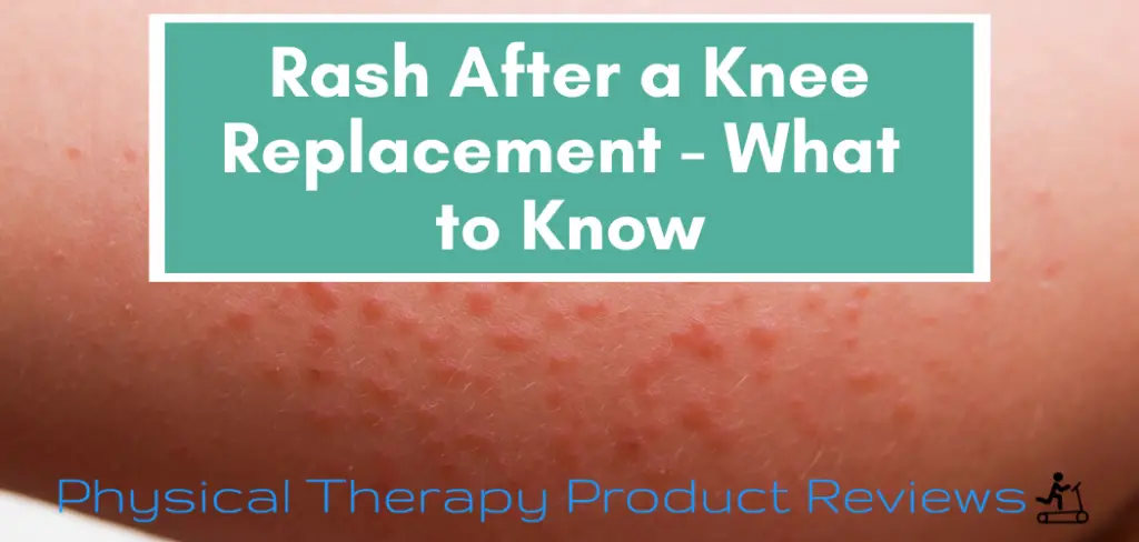 A rash after a total knee replacement guide