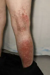 Contact Dermatitis in the leg