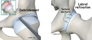 types of hip labral surgeries