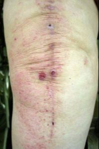 Metal allergy after a knee replacement