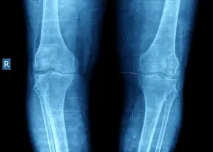 knee x-ray