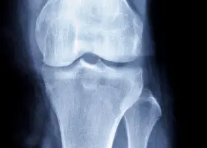 knee xray