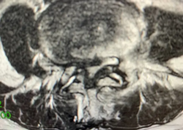 Severe Lumbar Stenosis on MRI