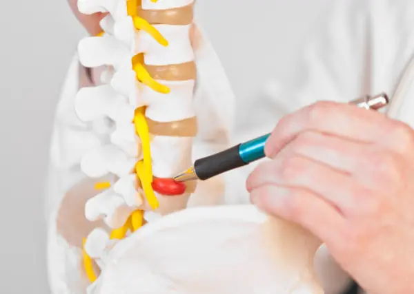 Lumbar disk herniation model