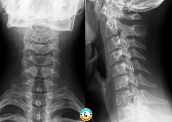 Cervical Xrays 