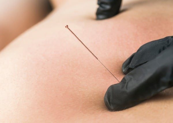 dry needling 2 Dry Needling